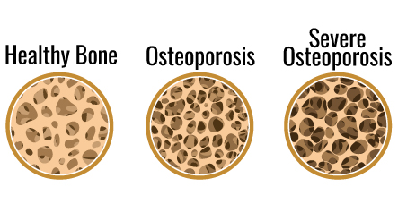 Progression of osteoporosis within bones